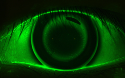 Case study: ortho-k for a patient with astigmatism