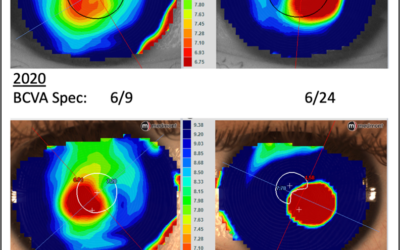 Case Report: Topography’s Role in Early Keratoconus Detection