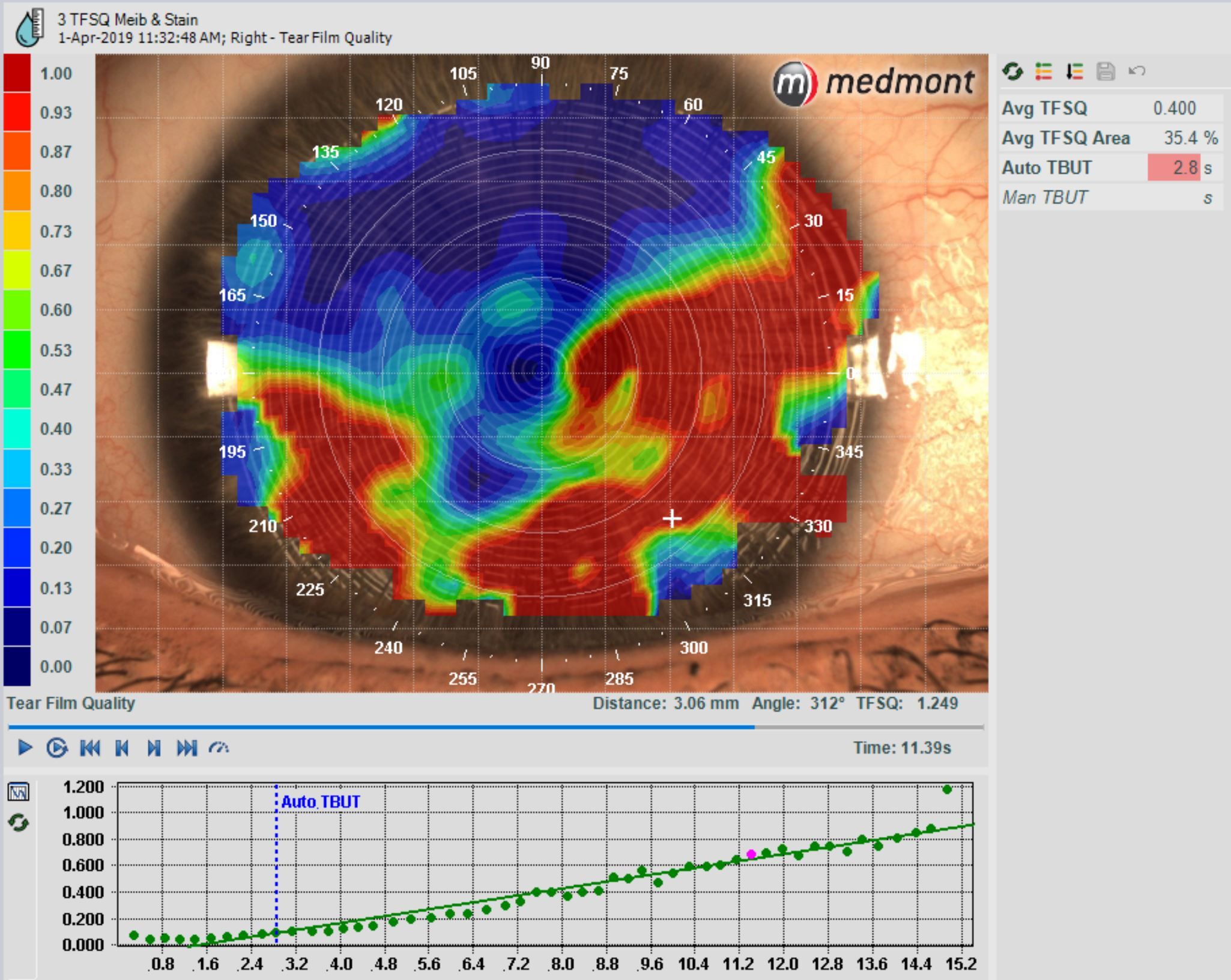 Optometry-Practice-Tear-Film-Analysis